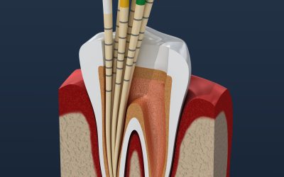 Cemento endodontico: cos’è e perché è fondamentale nell’otturazione canalare