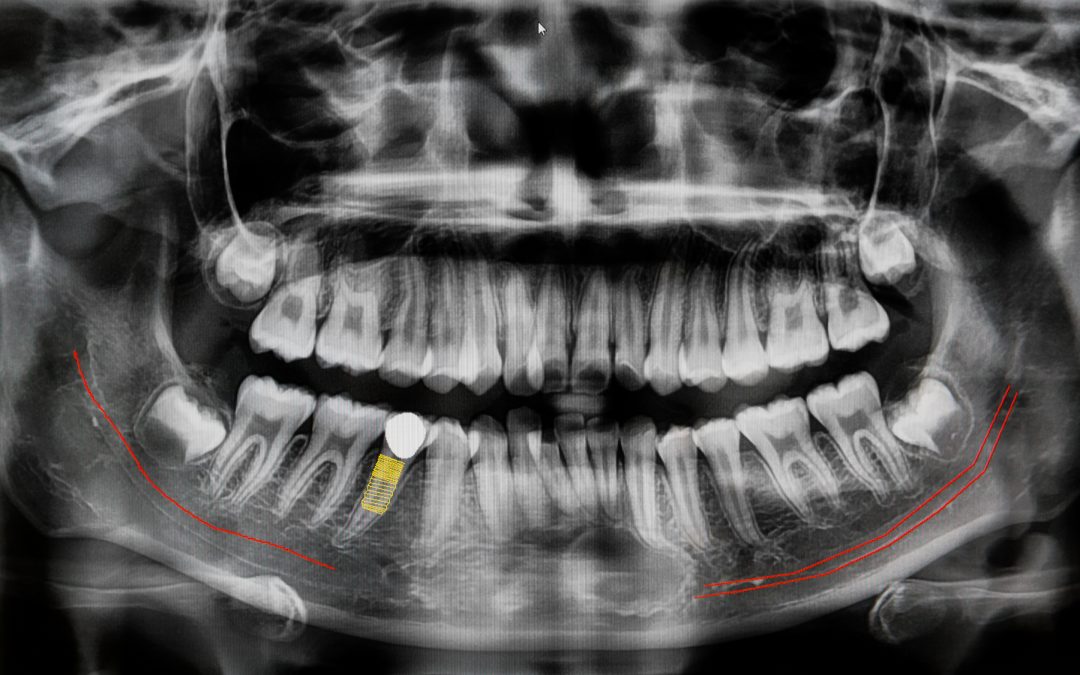 Anestesia tronculare del nervo alveolare inferiore: spiegazione semplice