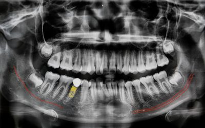 Anestesia tronculare del nervo alveolare inferiore: spiegazione semplice