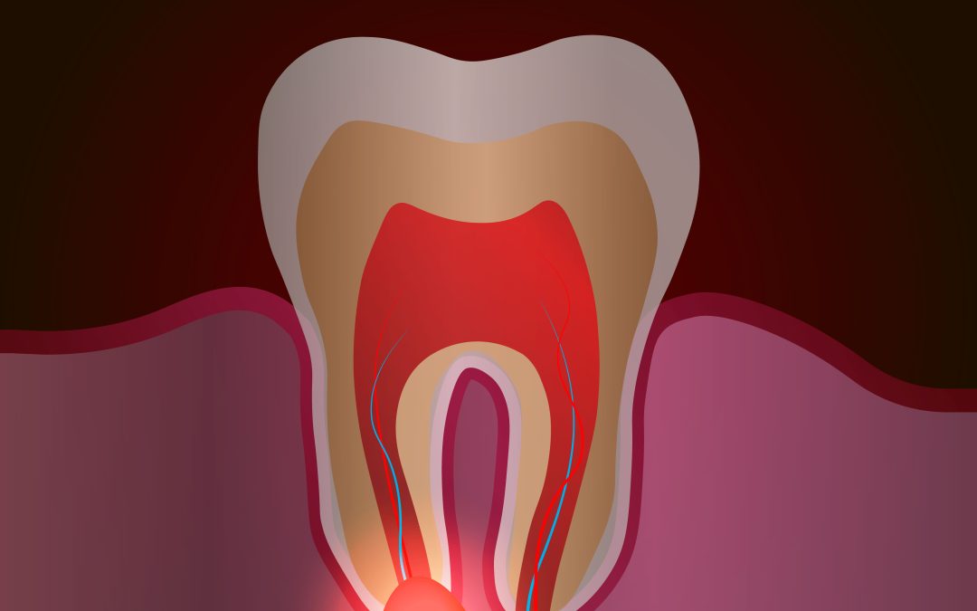 Come si svolge un’apicectomia: fasi, benefici e decorso