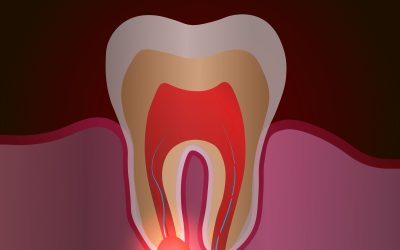 Come si svolge un’apicectomia: fasi, benefici e decorso
