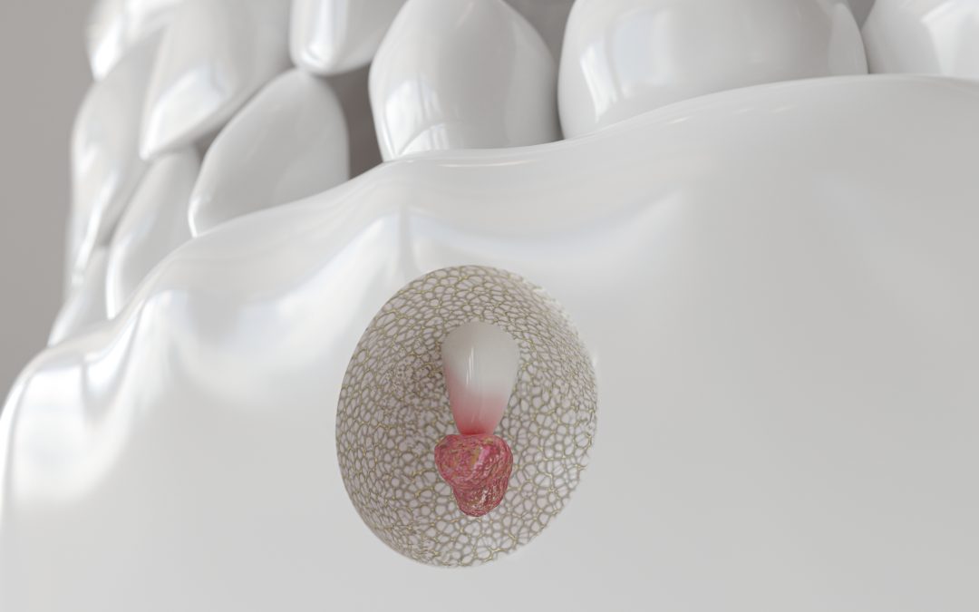 Apicectomia: cos’è, quando è necessaria e come funziona