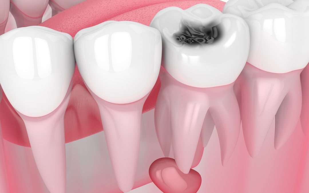 Cisti dentale: cause e sintomi