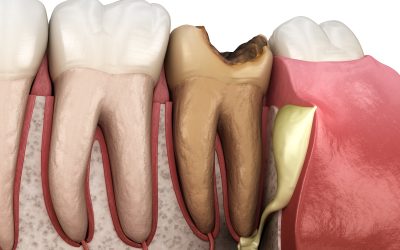 Ascesso dentale: cosa sono l’apicale e il parodontale