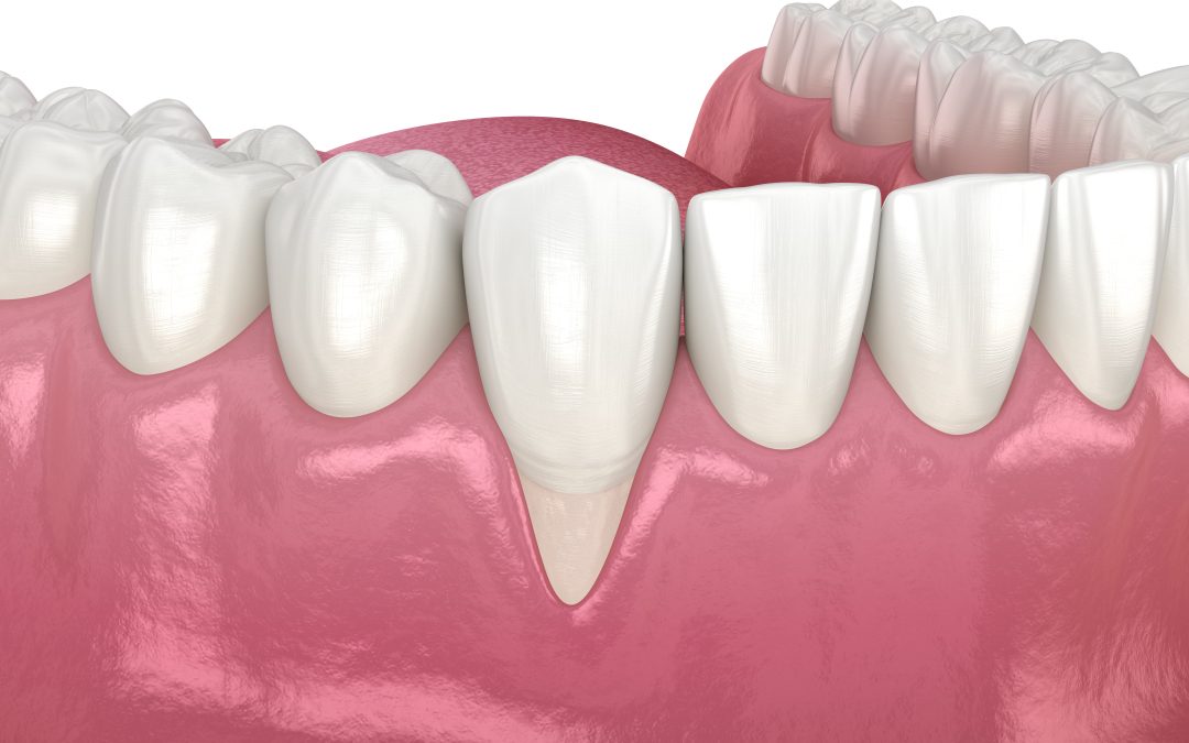 Recessione gengivale: cosa comporta e come intervenire