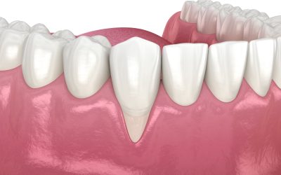 Recessione gengivale: cosa comporta e come intervenire