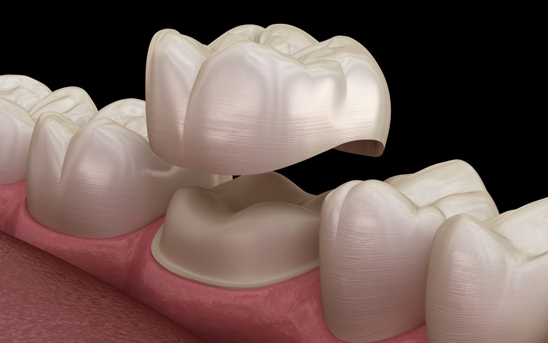 Differenza tra corona dentale e corona protesica: cosa sapere