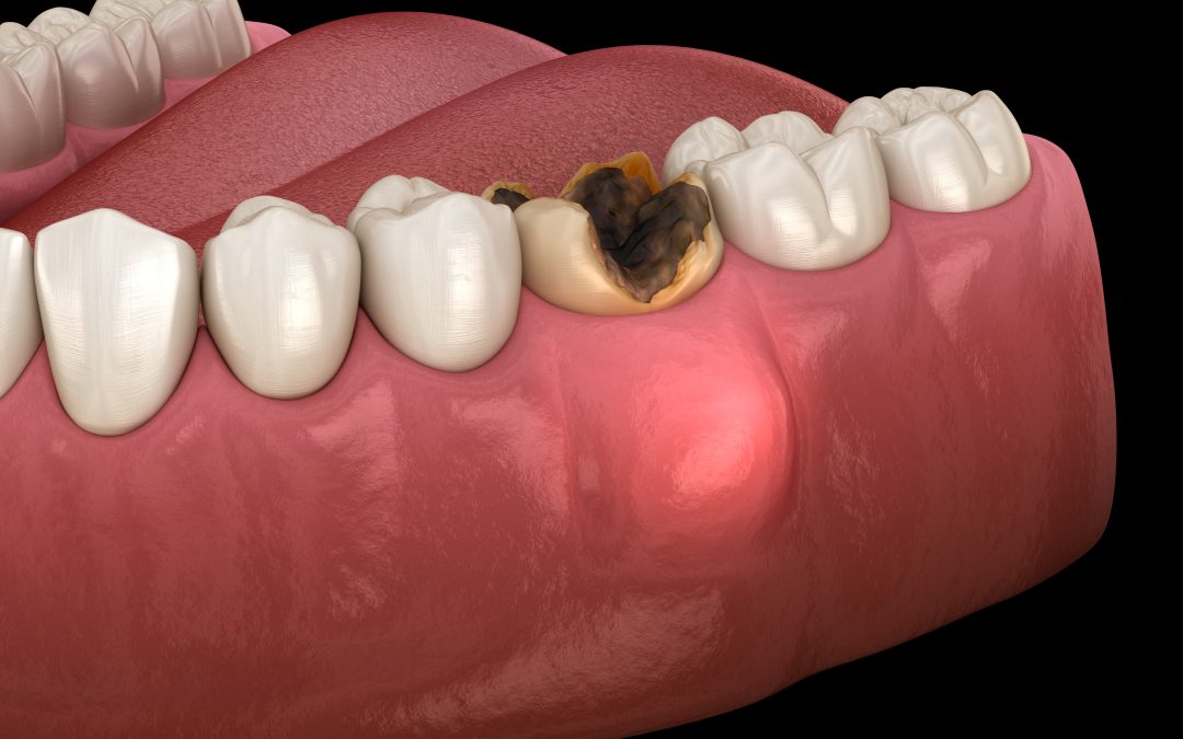 Cisti dentali: differenze tra radicolare, follicolare e parodontale