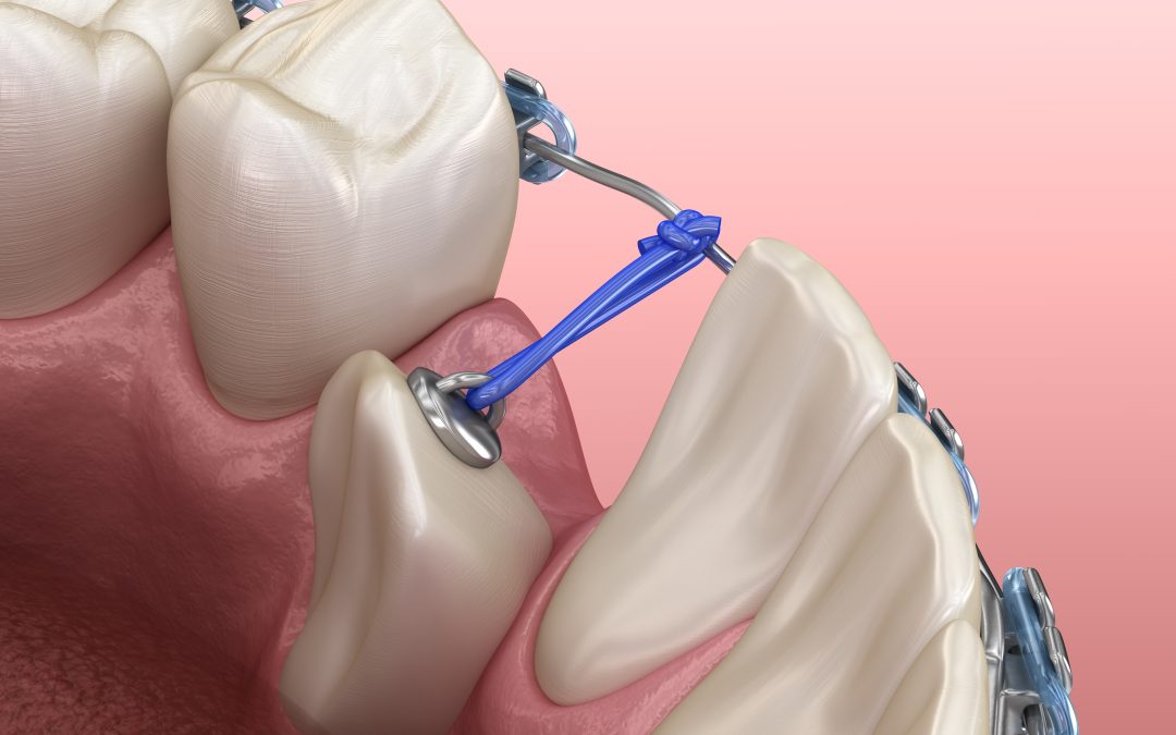 Affollamento e palato stretto: le cause dei denti inclusi