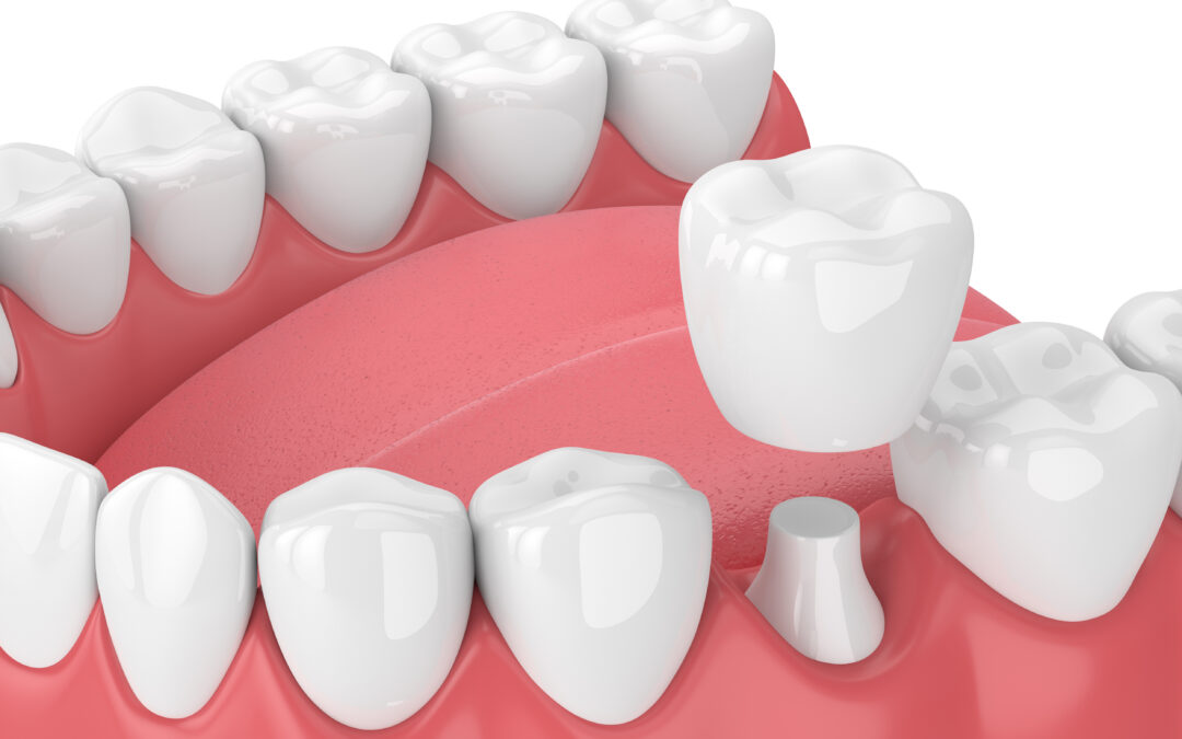 Come si applica una corona protesica: procedure e fasi del trattamento
