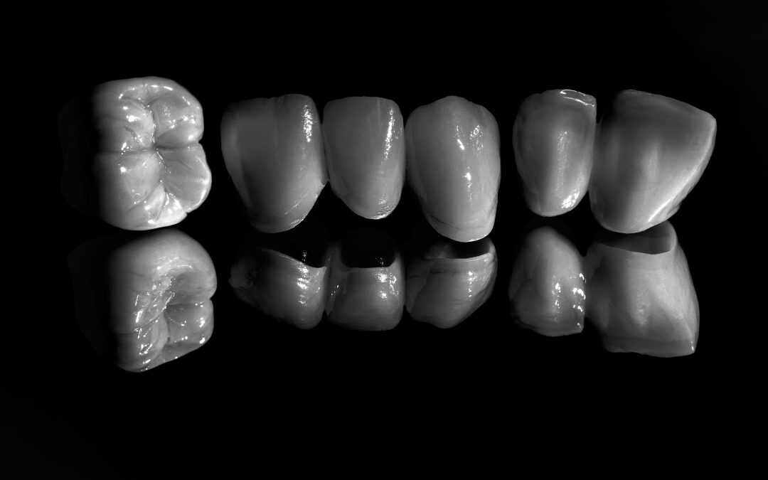 Corone dentali senza metallo: più estetica e naturalezza nel tempo