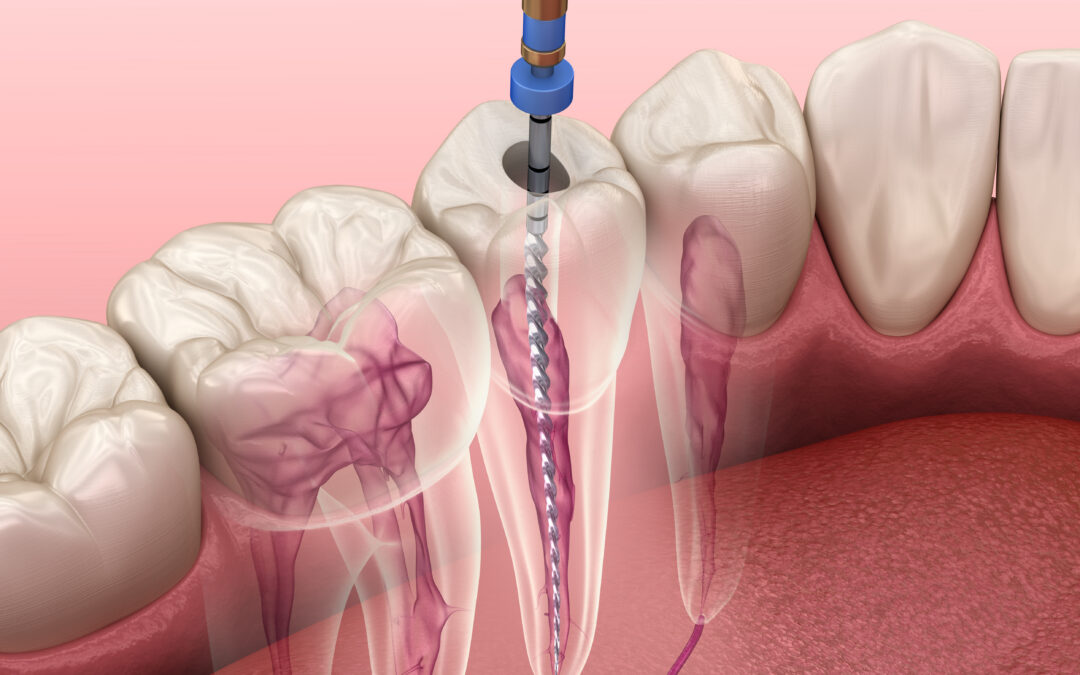 Il Trattamento Endodontico: Anatomia e Procedure della Devitalizzazione