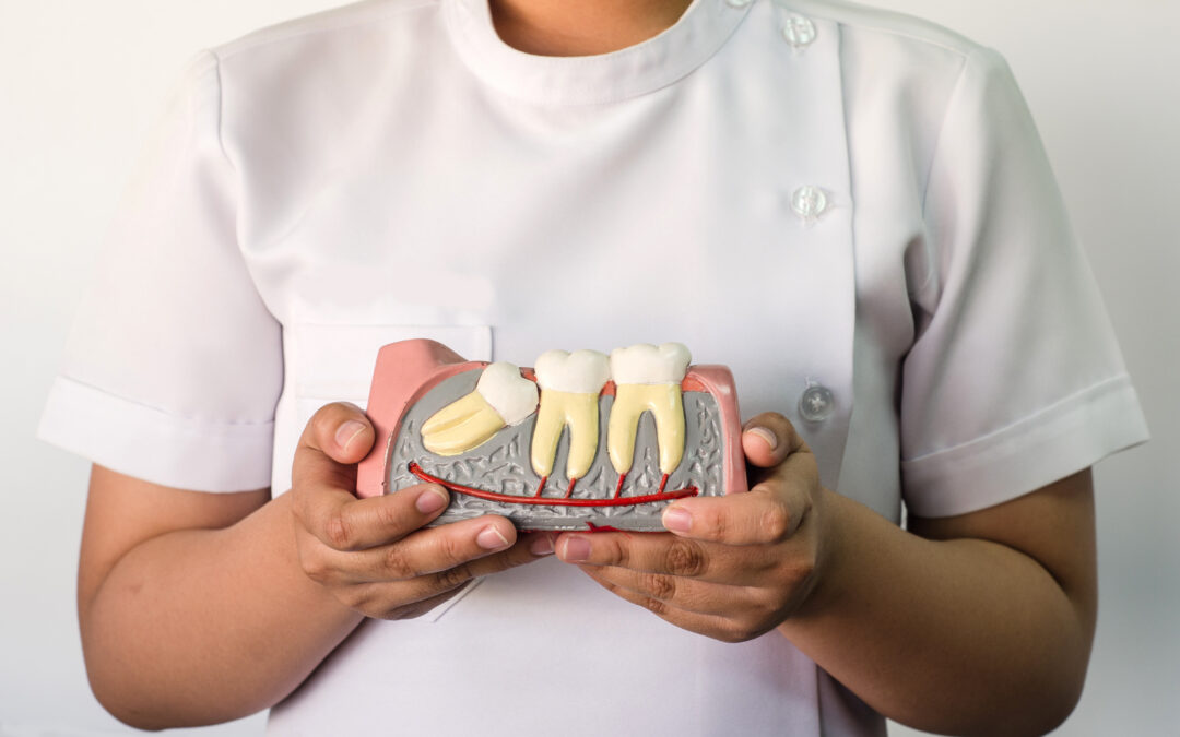 Perché non dovresti sottovalutare un dente del giudizio parzialmente estratto