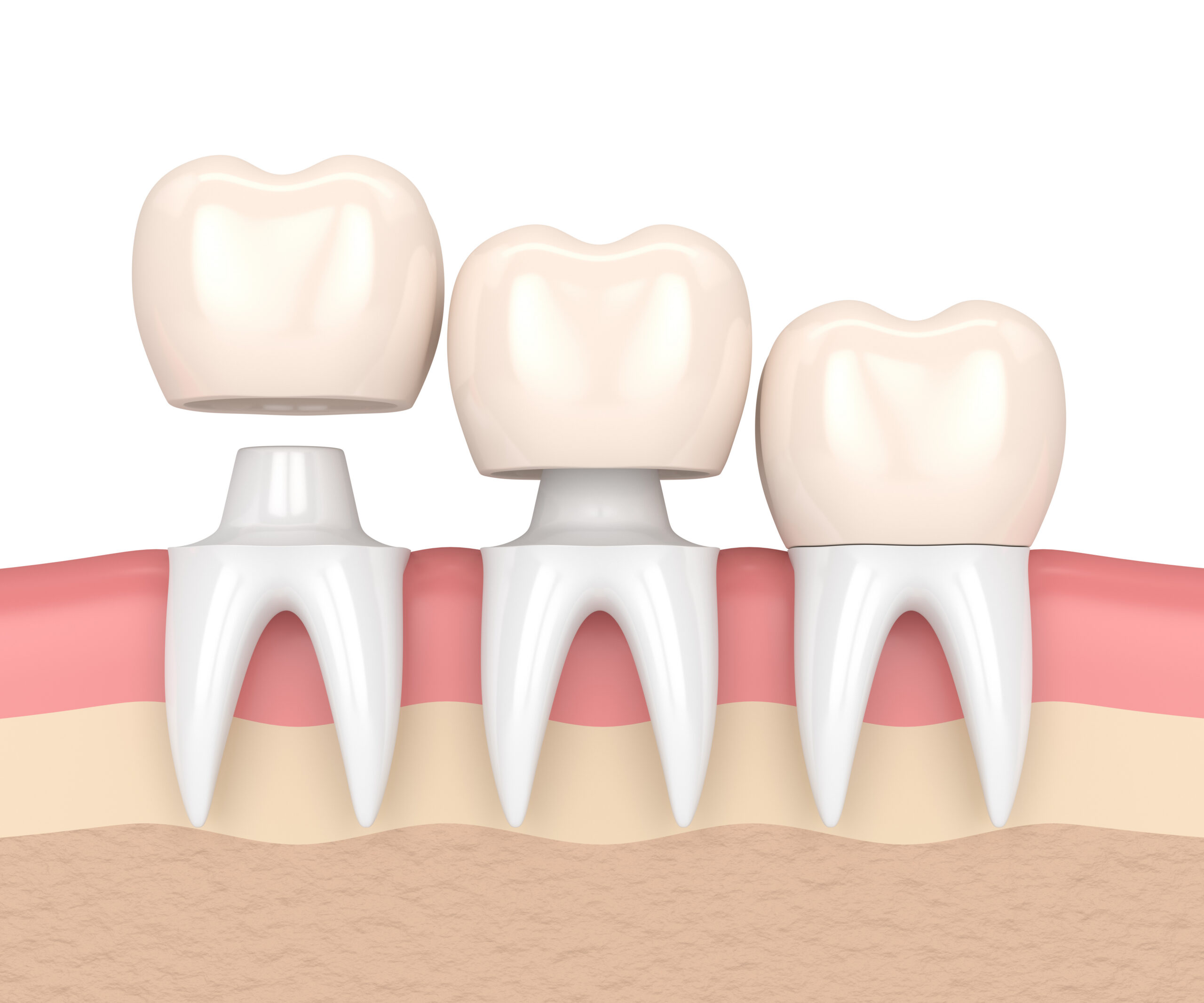 Cementi Dentali: Perché a volte il dentista sceglie una soluzione “a tempo”